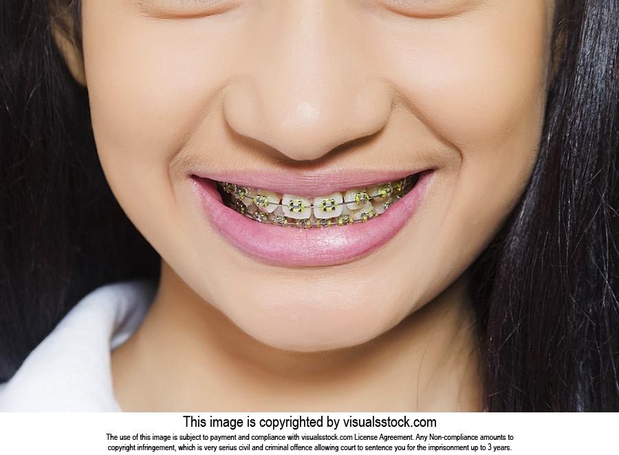 Teenage Girl Showing Braces Teeth