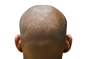1 Person Only ; 25-30 Years ; Adult Man ; Balding 